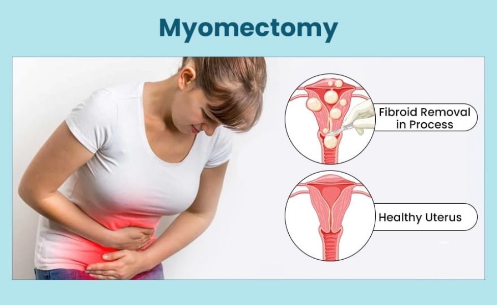 Myomectomy is a surgical procedure to remove ut... main image