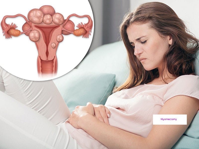 Doctors may recommend a M yomectomy (surgical r... main image