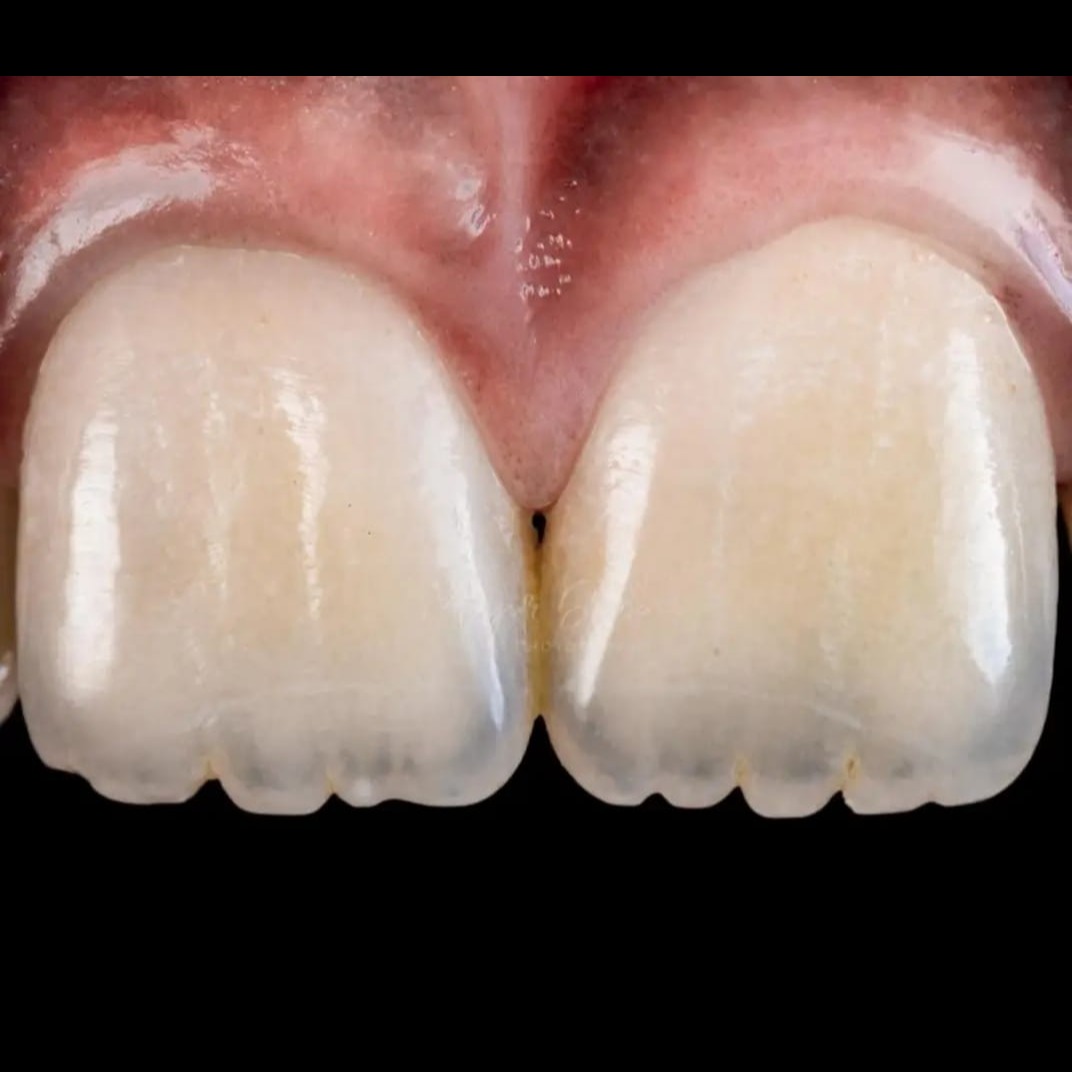 Wondering what those little ridges on your child’s... main image