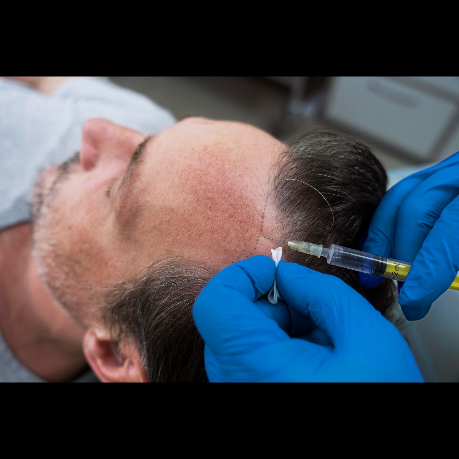 PRP and GFC Hair Regrowth Therapy in Nashik – Brin... main image