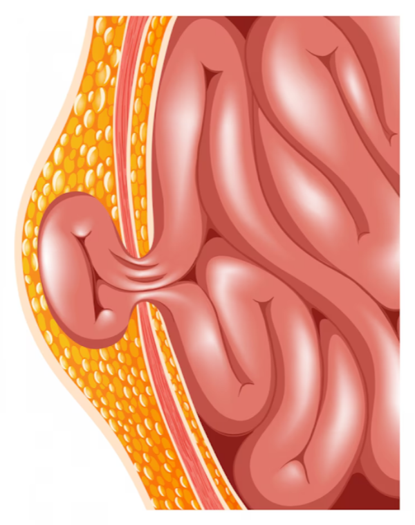 Hernia Surgery Hospital In Pune For Safe And Ef... main image