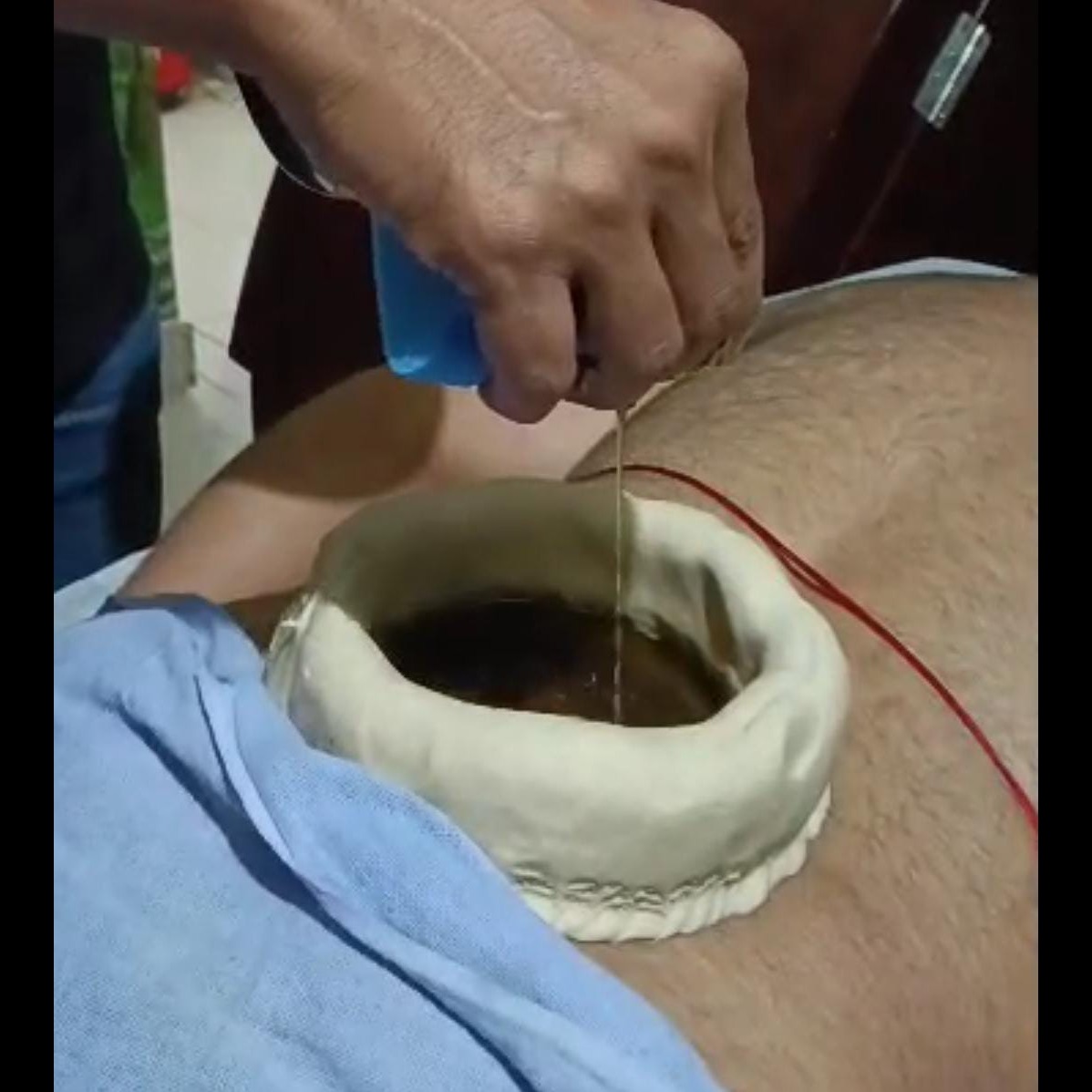 Kati Vasthi is a powerful Ayurvedic therapy spe... main image