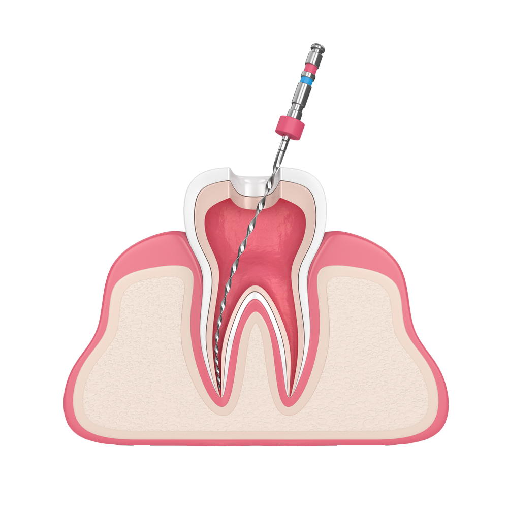 Emergency pain dentist near me Urgent root cana... main image