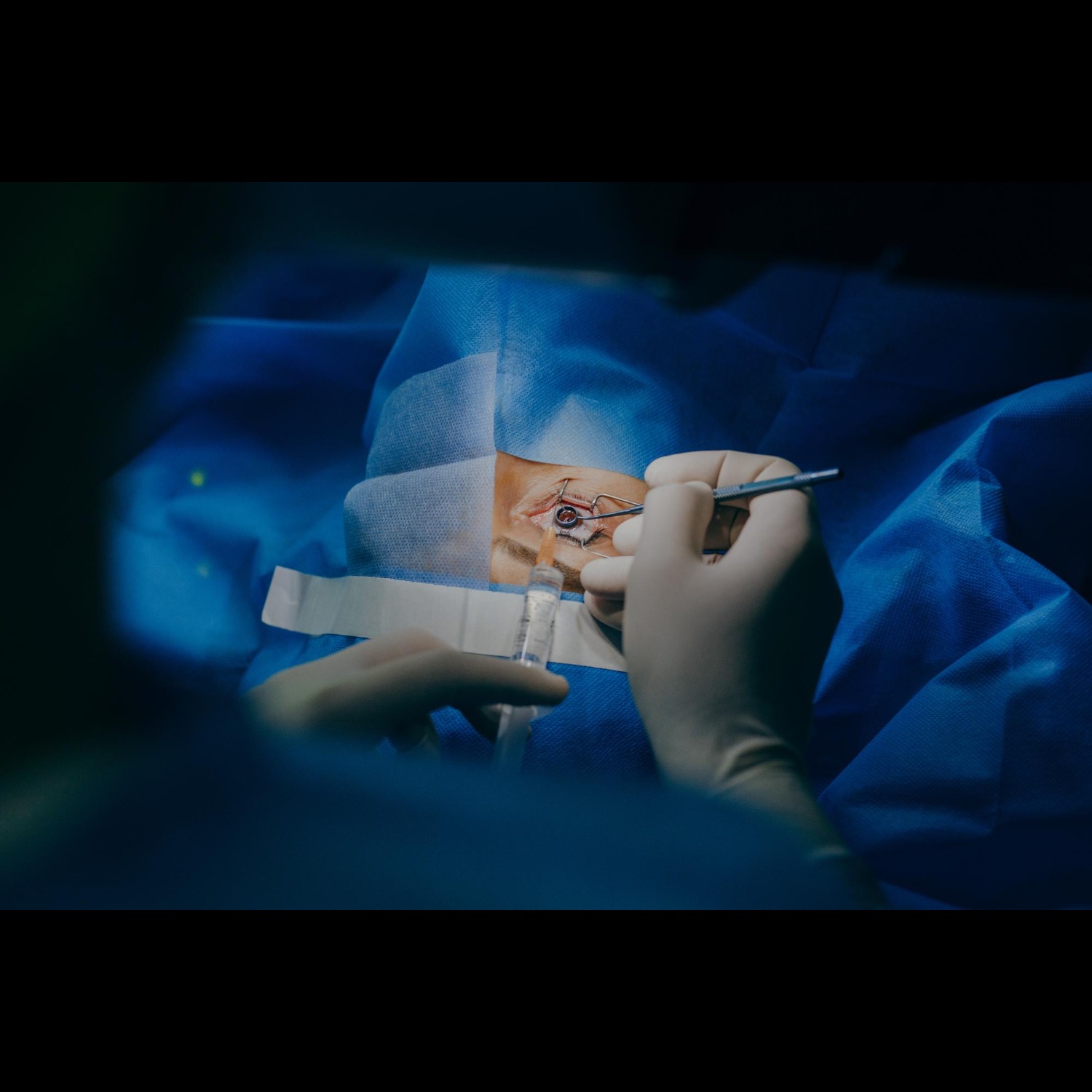 Micro-Incision Eye Surgery in Nagpur – Faster H... main image