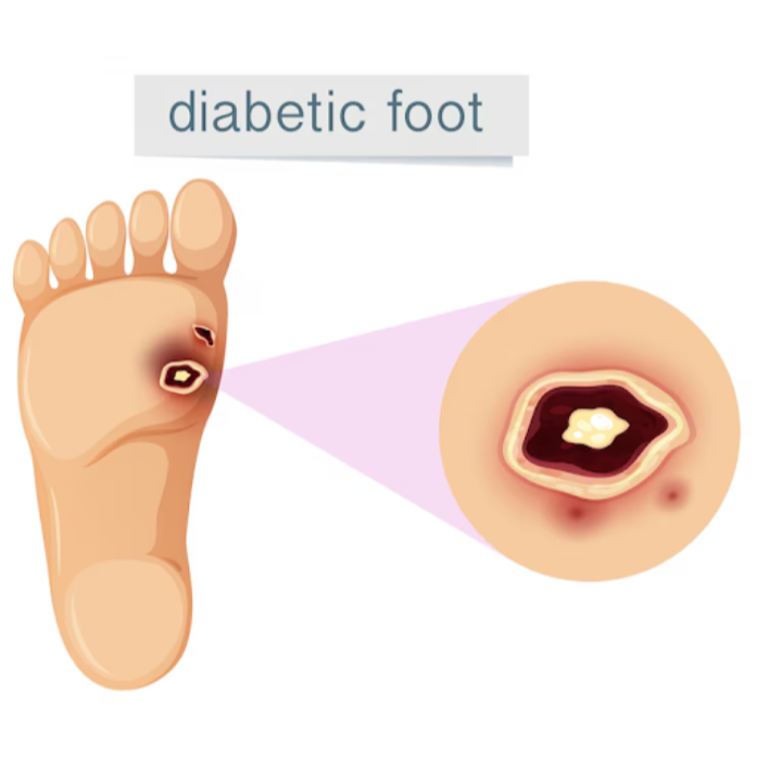 Diabetic Foot Surgeon in Dombivli – Specialized Di... main image
