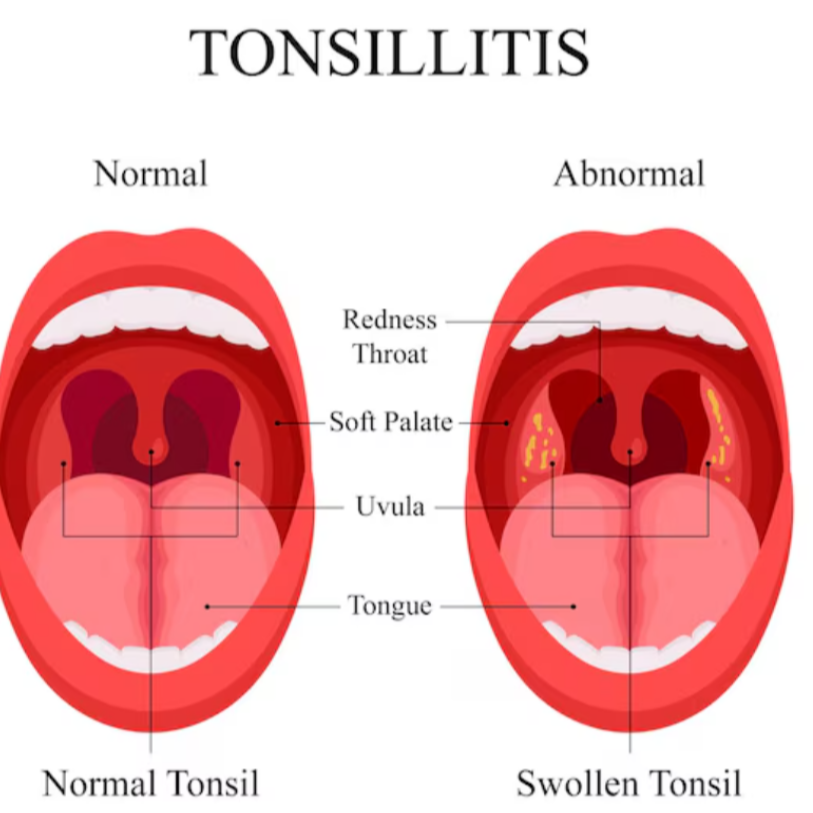 Tonsillitis Treatment in Jaipur Recurring sore thr... main image