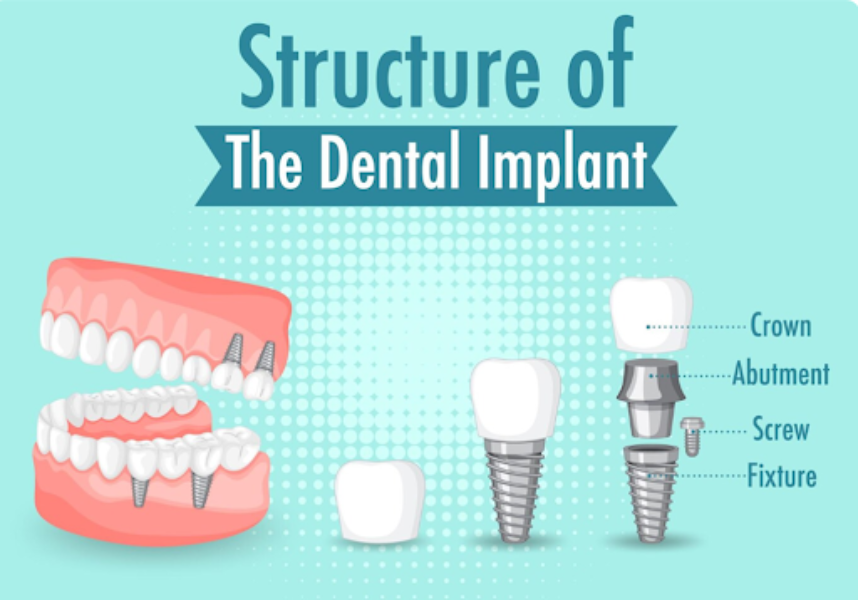 Conventional Dental Implants in Delhi for Relia... main image
