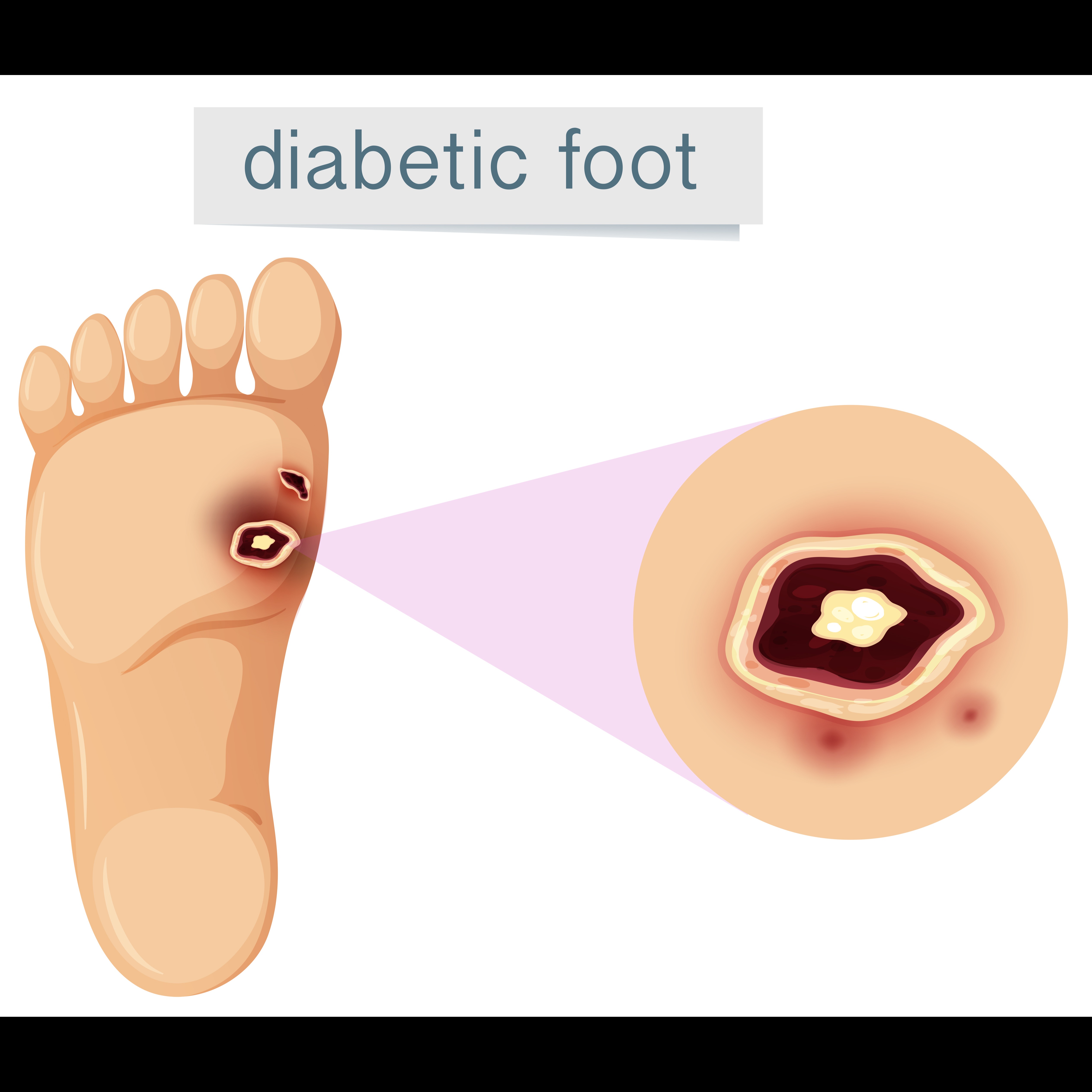 Diabetic Wound Care In Bangalore – Specialized Foo... main image