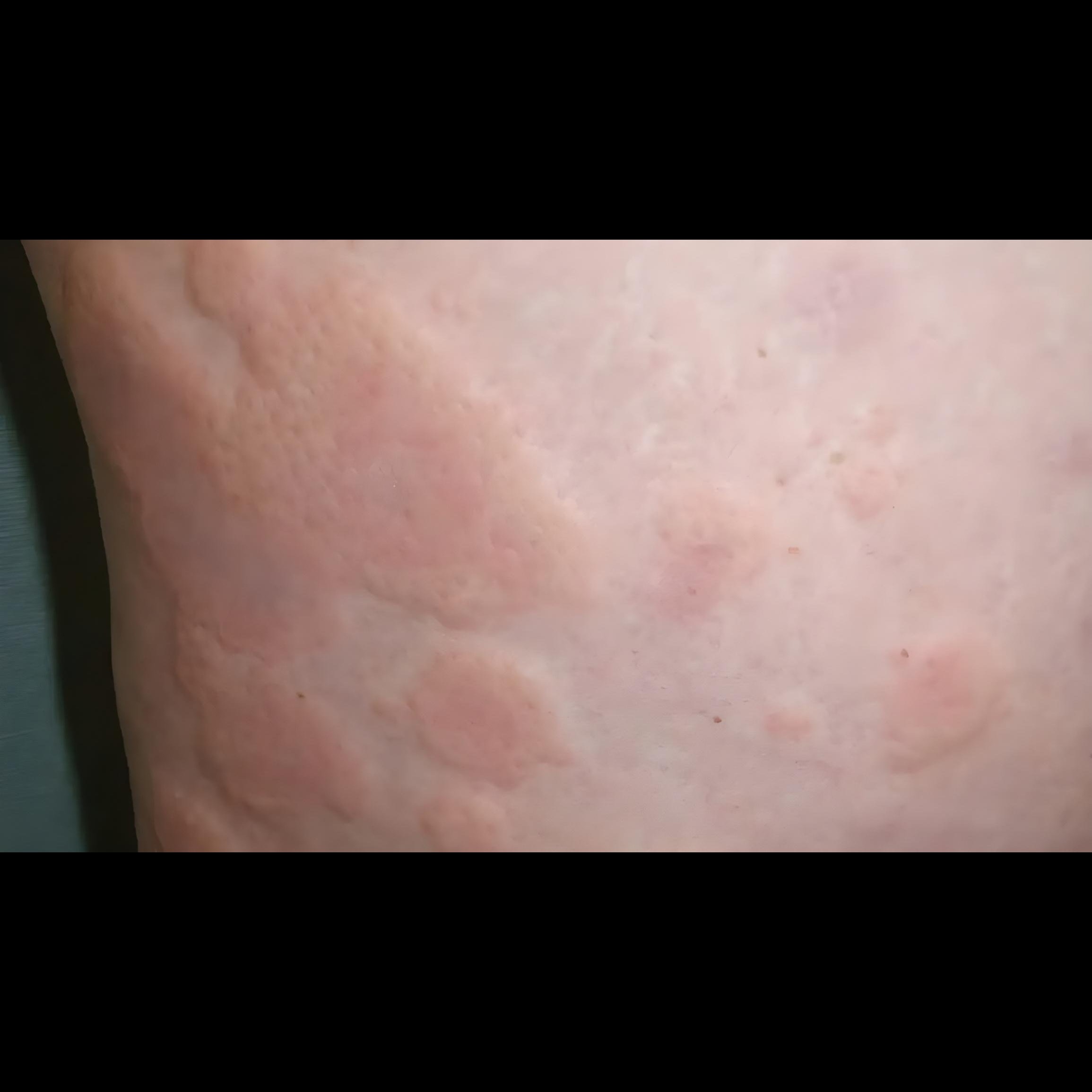 Ayurvedic Treatment for Urticaria in Pune – Cal... main image