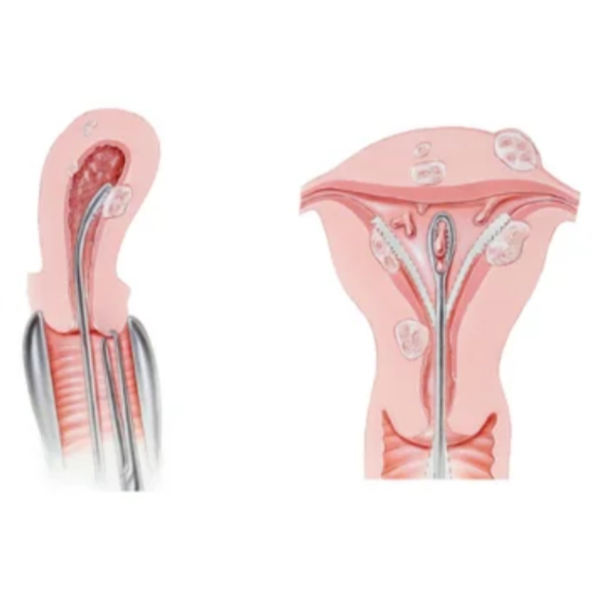 Hysteroscopic Septum Resection in Chennai – Min... main image