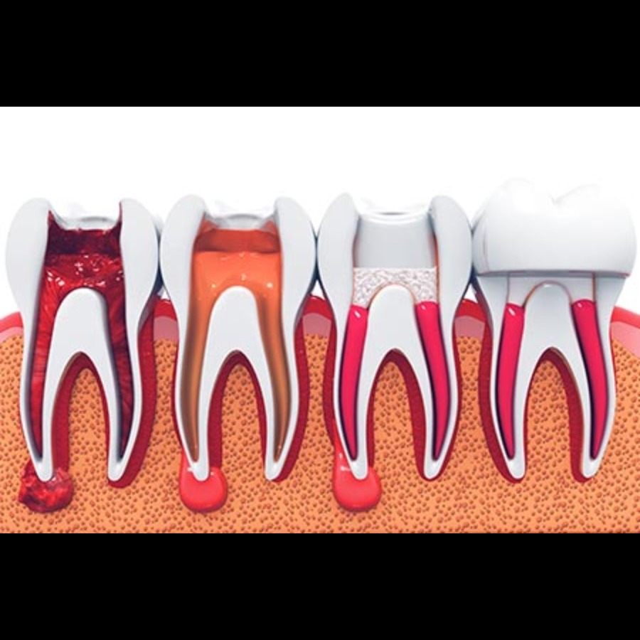 Painless Root Canal and Dental Care in Nashik – Ge... main image