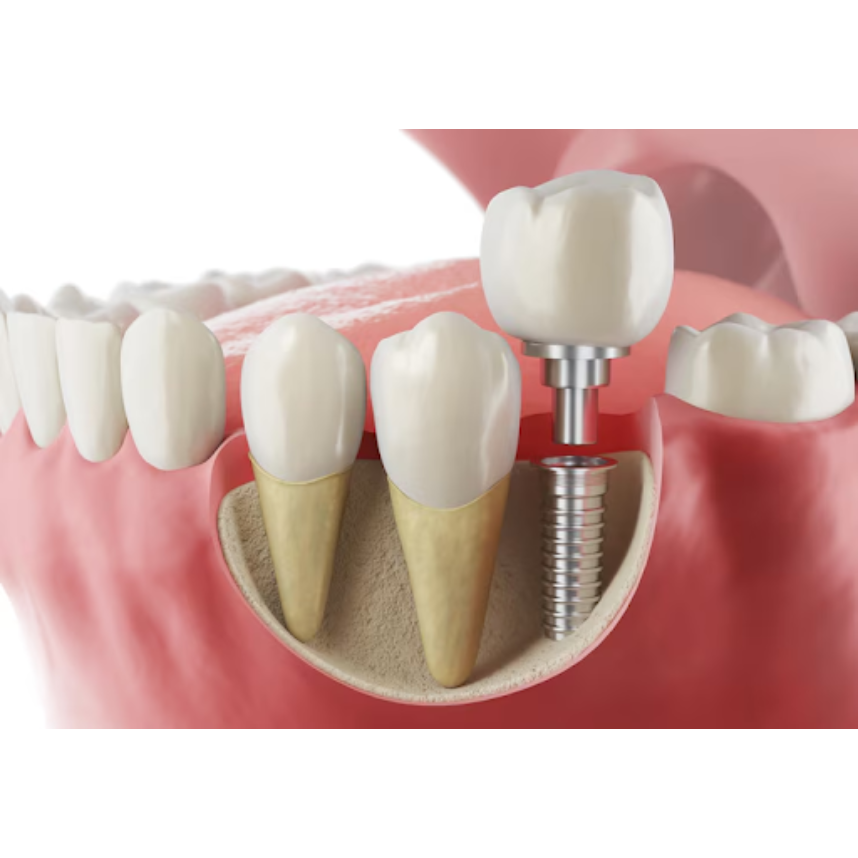 Best Dental Implants in Nagpur for Stronger Too... main image