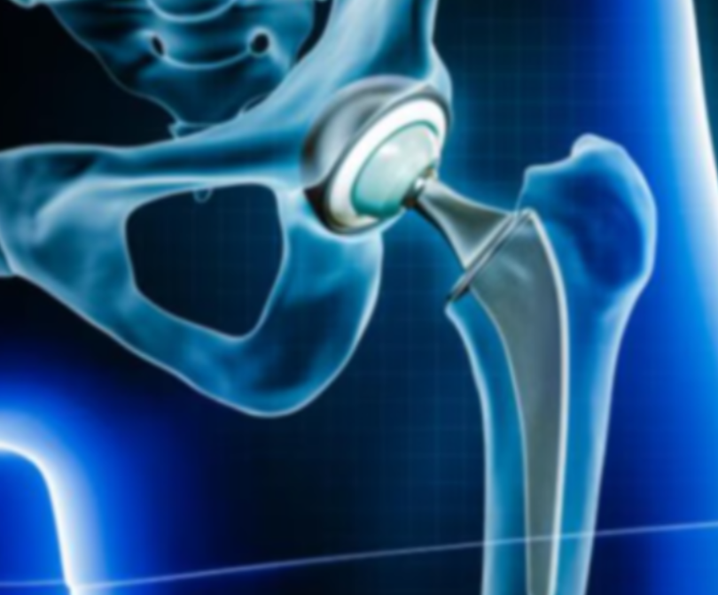 Hip Replacement in Chennai: Regain Mobility and Co... main image