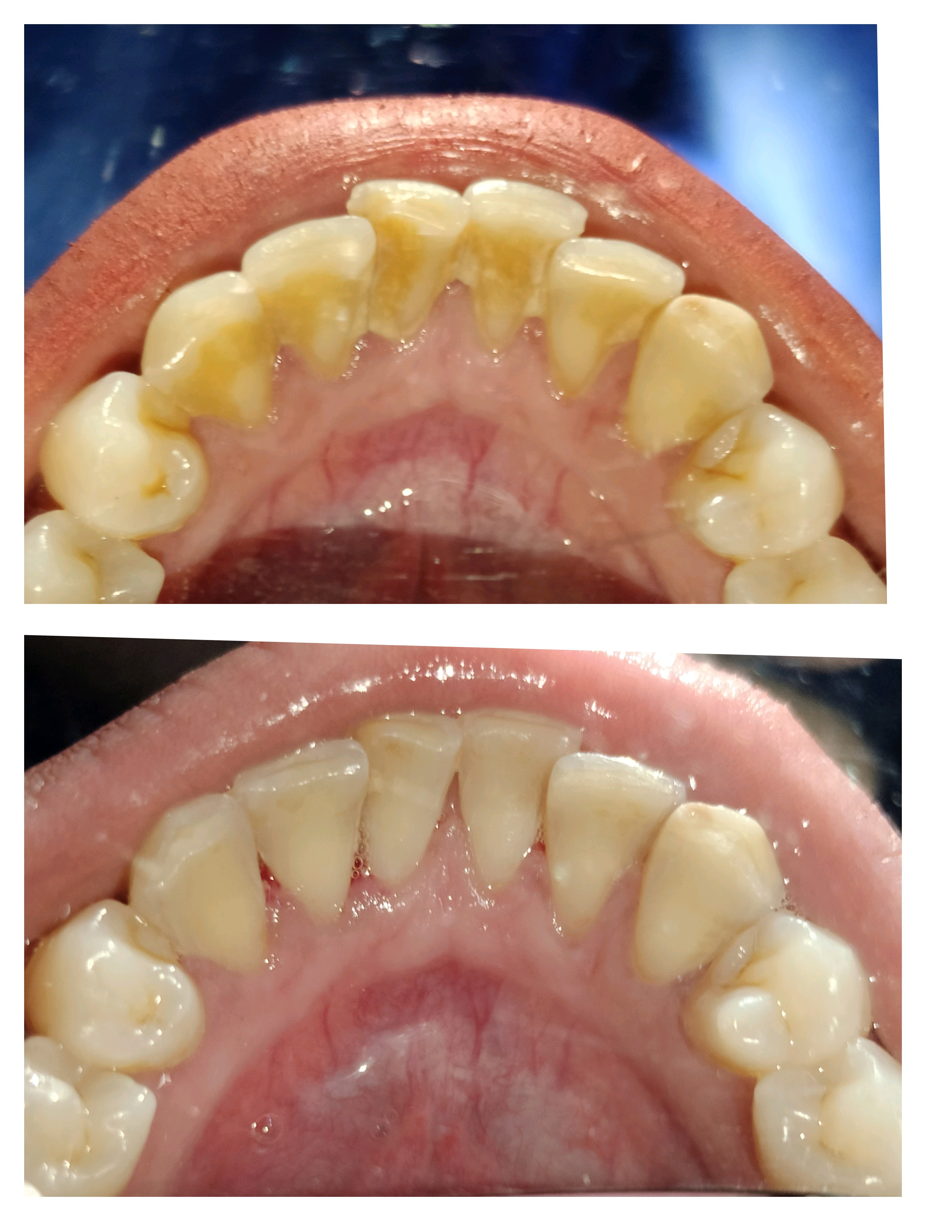 Teeth cleaning near me Teeth cleaning in Mira R... main image