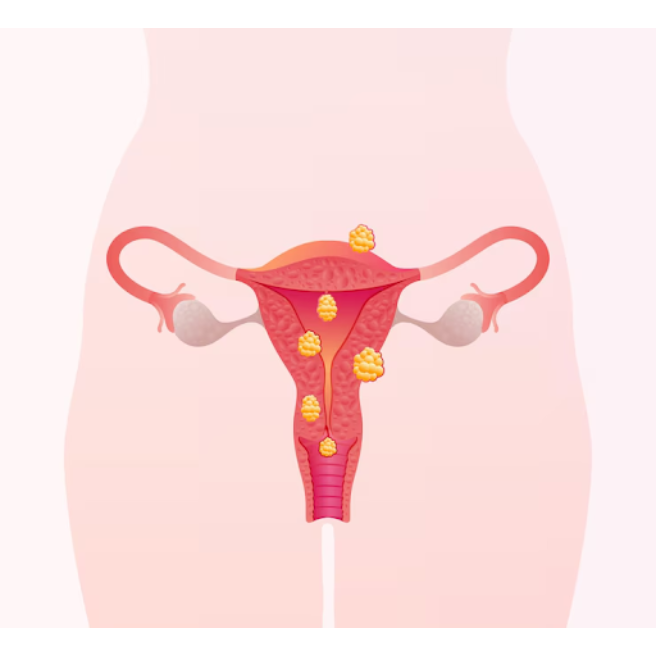 Fibroids Treatment in Chennai for Uterine Health a... main image