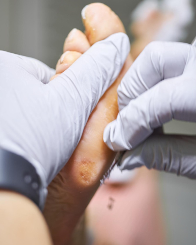 Debridement Treatment In Bangalore – Professional ... main image