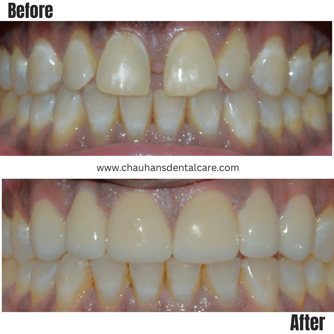 Smile transformation in no time!
This patient want... main image