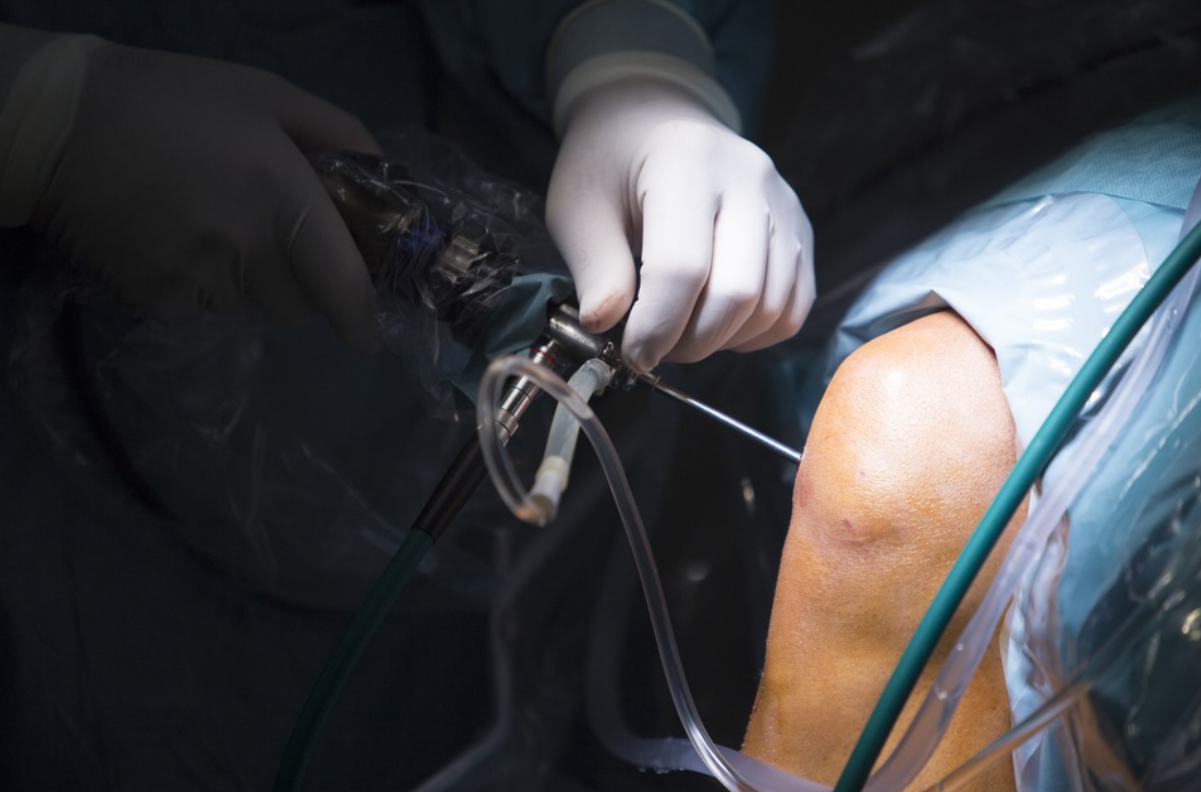 Knee Arthroscopy in Nagpur for Quick Recovery a... main image