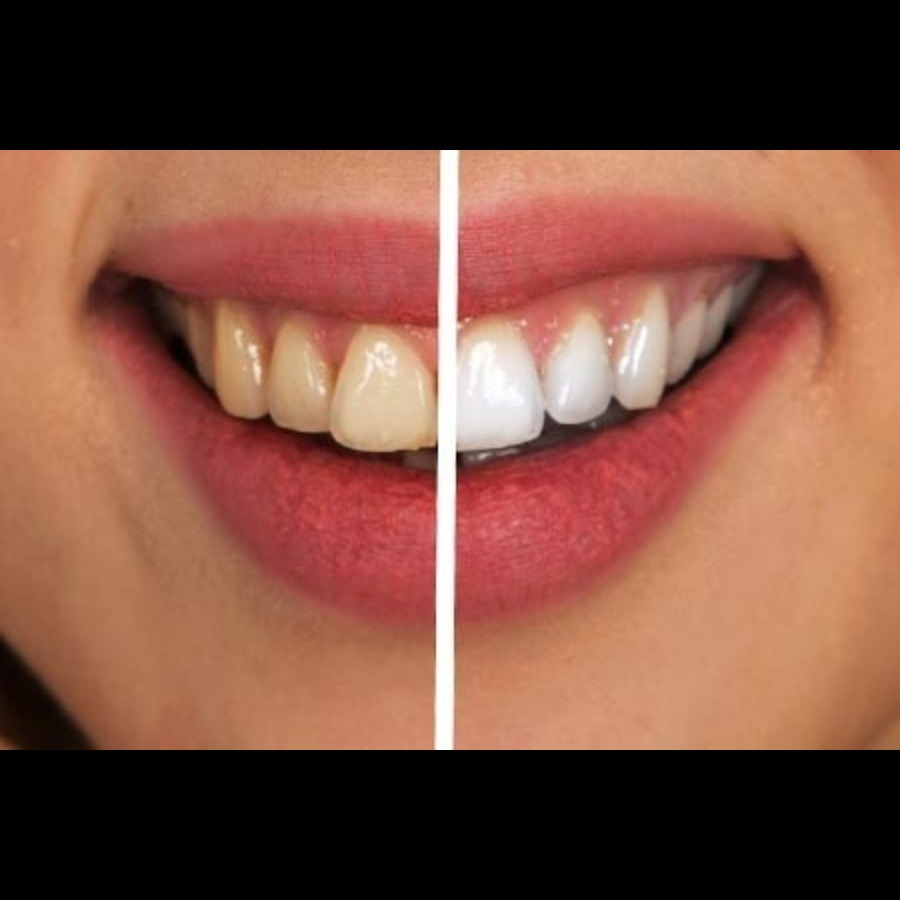 Teeth Whitening and Veneers in Nashik – Brighten Y... main image