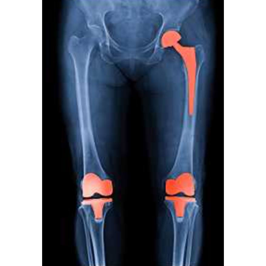 Specialized Knee and Hip Transplants in Rasta P... main image