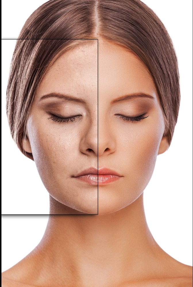 Pigmentation Treatment in Delhi – Say Goodbye to U... main image