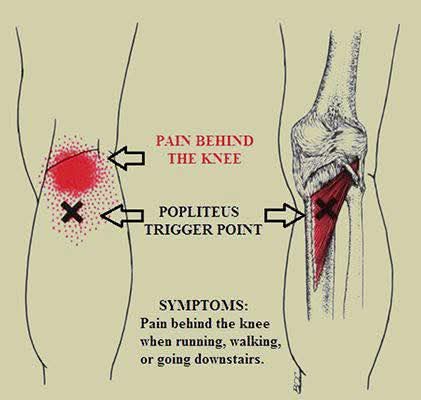 The popliteus muscle truly is the tiny muscle of k... main image