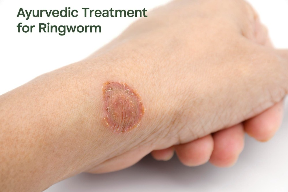 Ayurvedic Treatment for Ringworm in Pune – Stop... main image