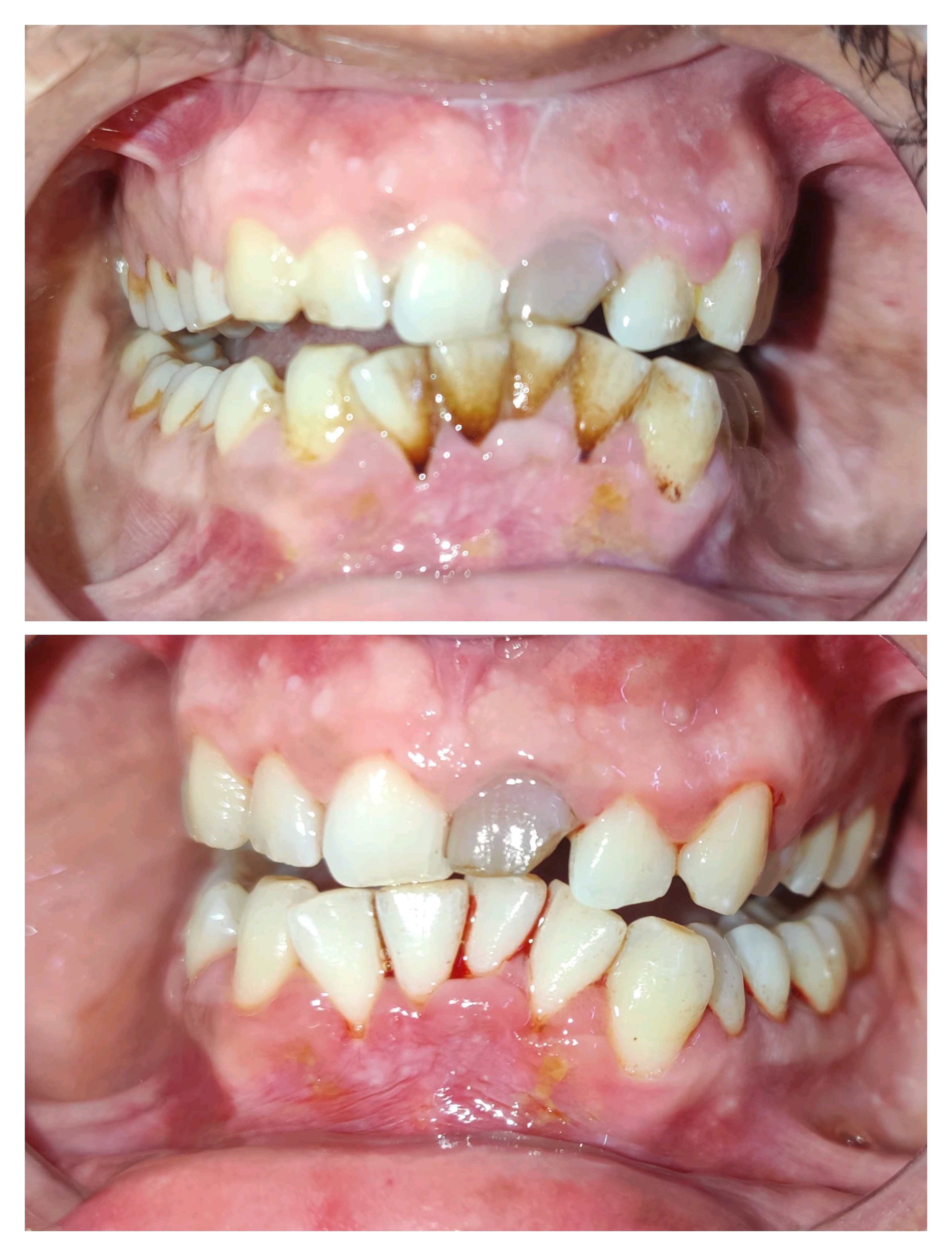 Single sitting teeth cleaning near me Tooth sta... main image