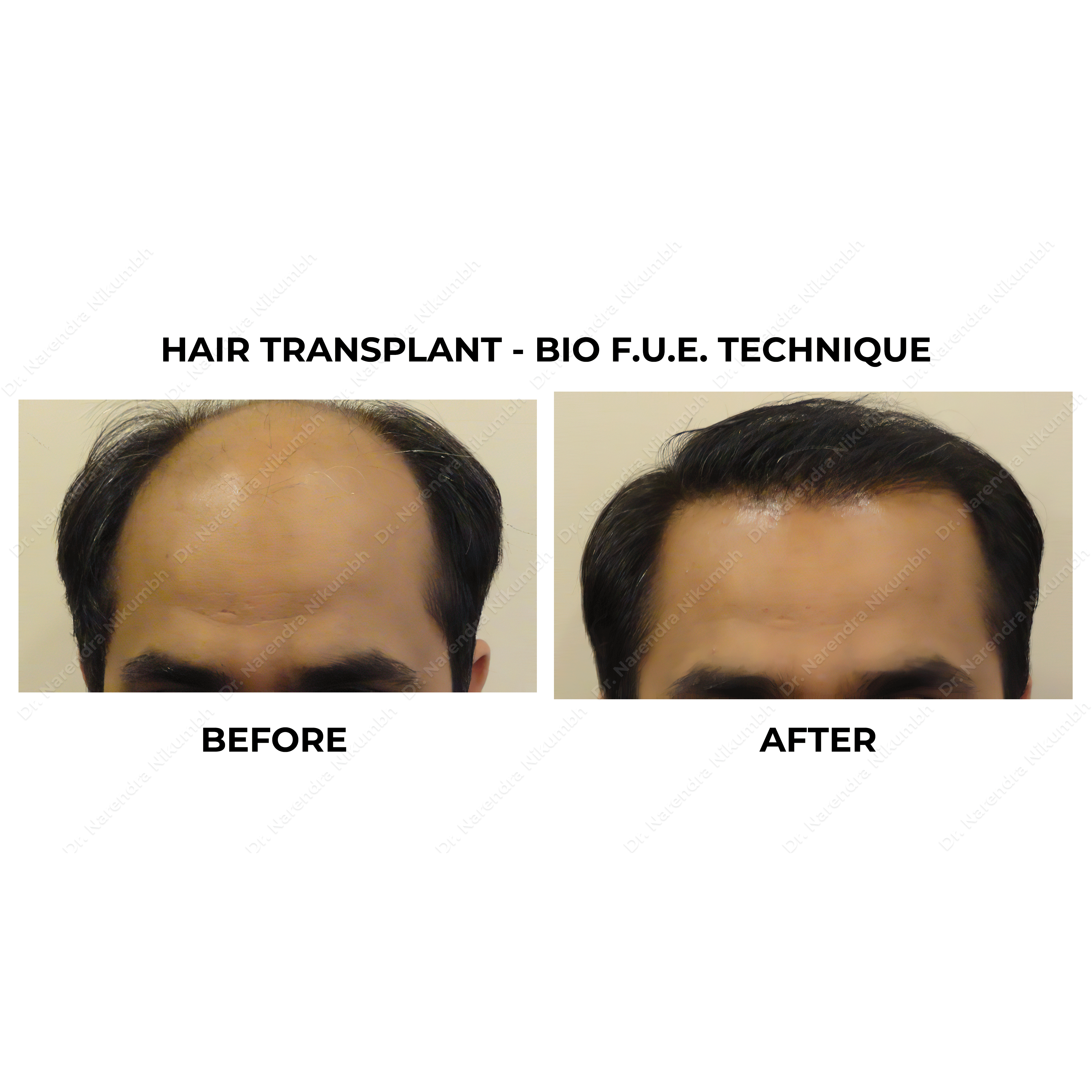 Best Hair Transplant Clinic in Thane
Best Hair ... main image