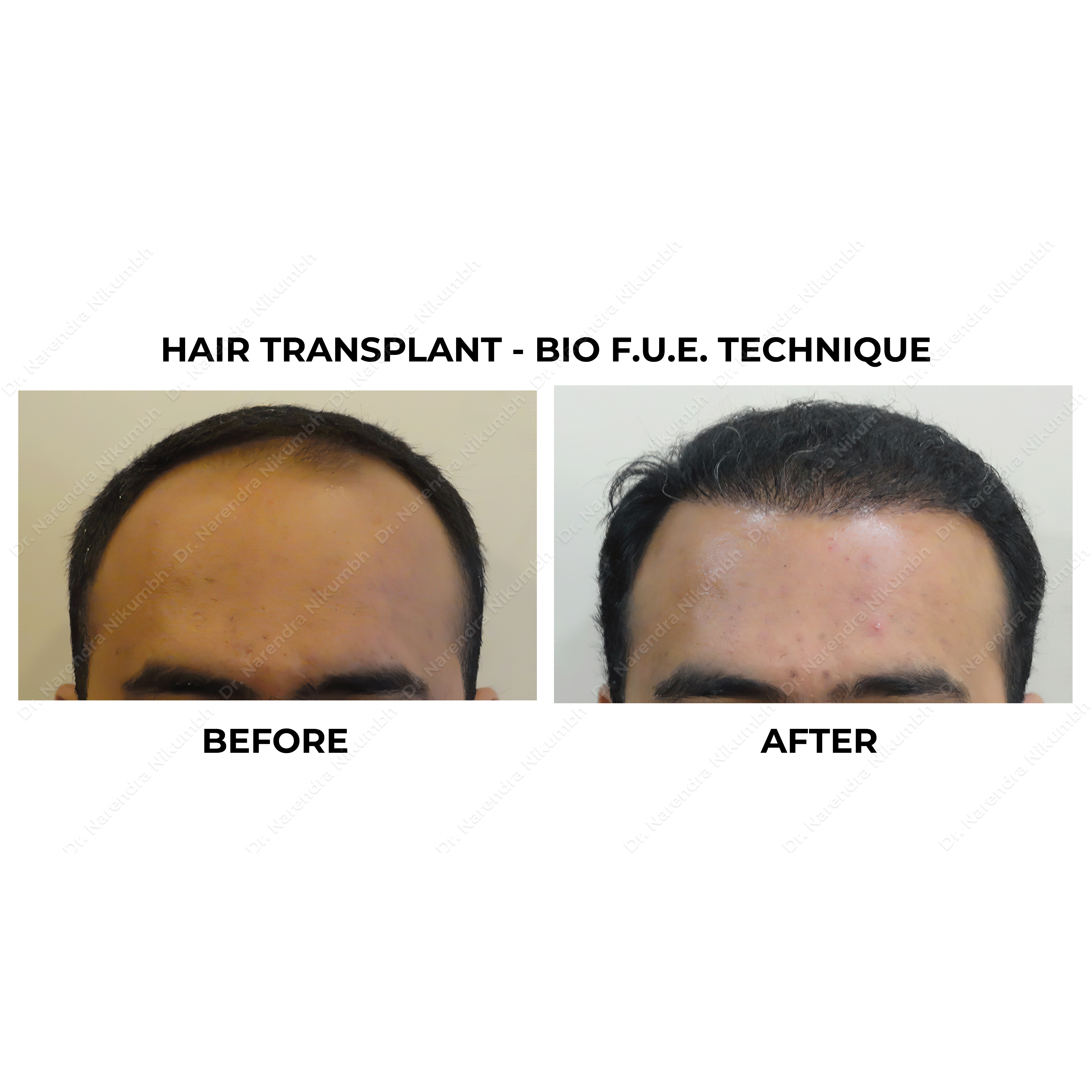 Best Hair Transplant Clinic in Thane
Best Hair ... main image
