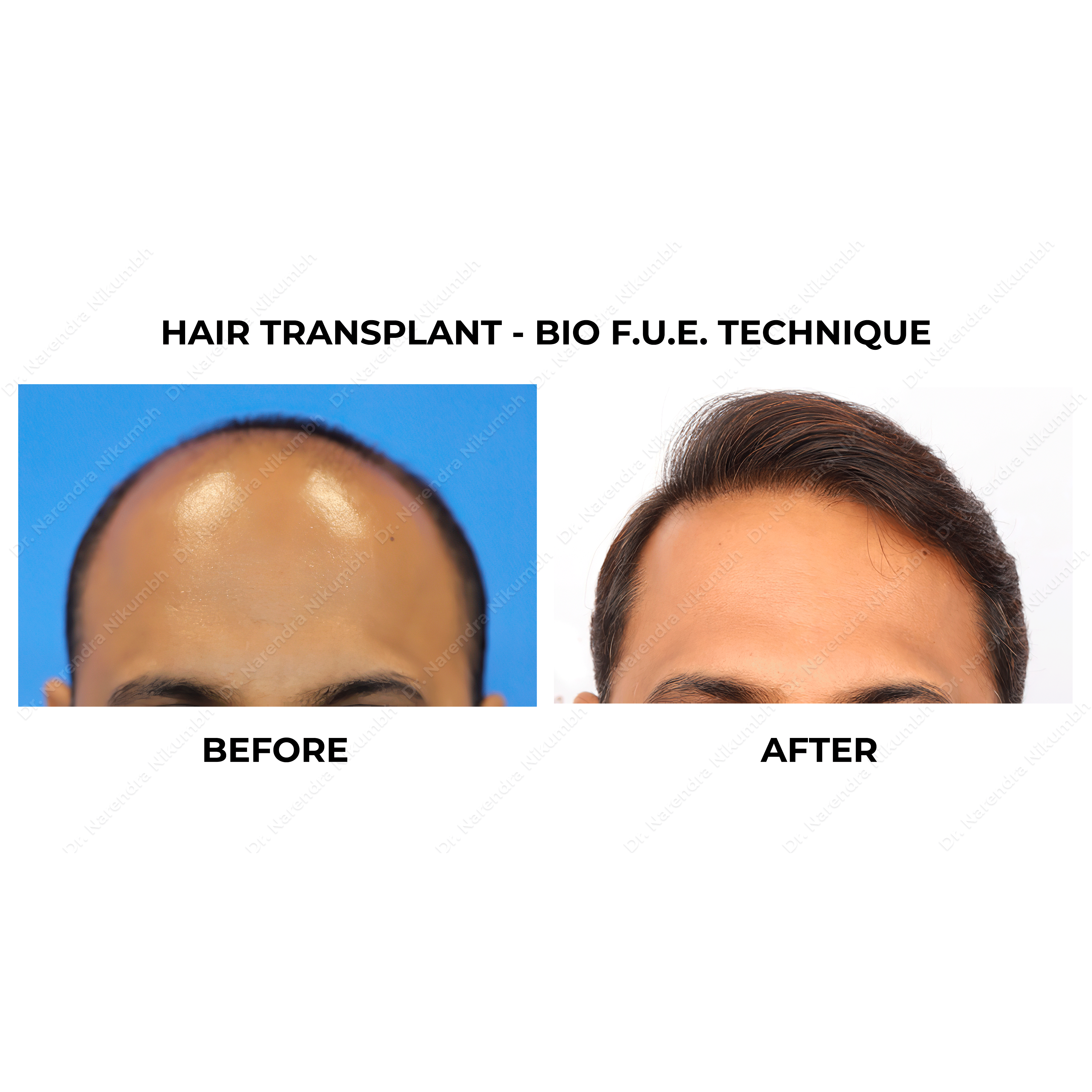 Best Hair Transplant Clinic in Thane
Best Hair ... main image