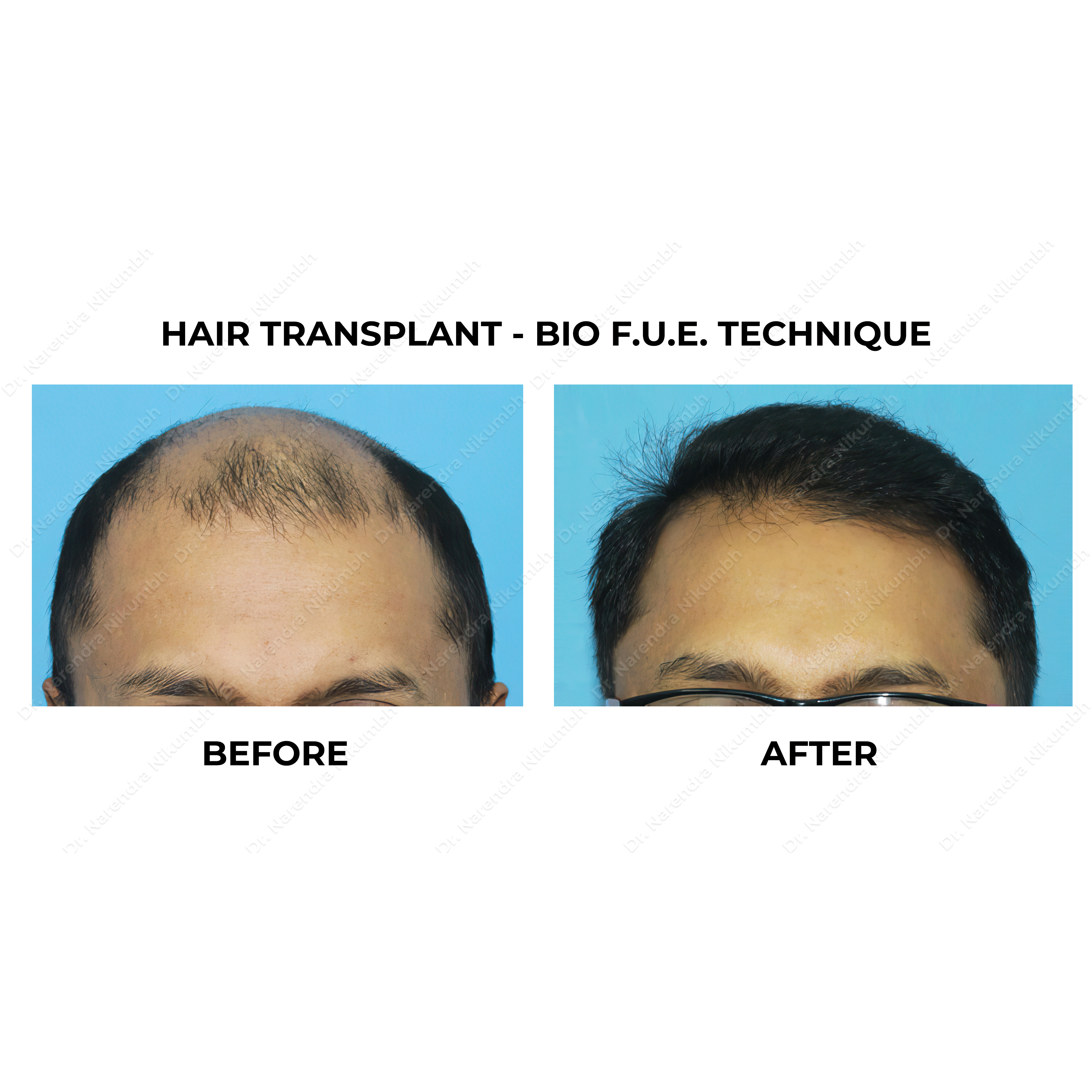 BIO FUE hair transplant Thane

Bio enhanced FUE... main image