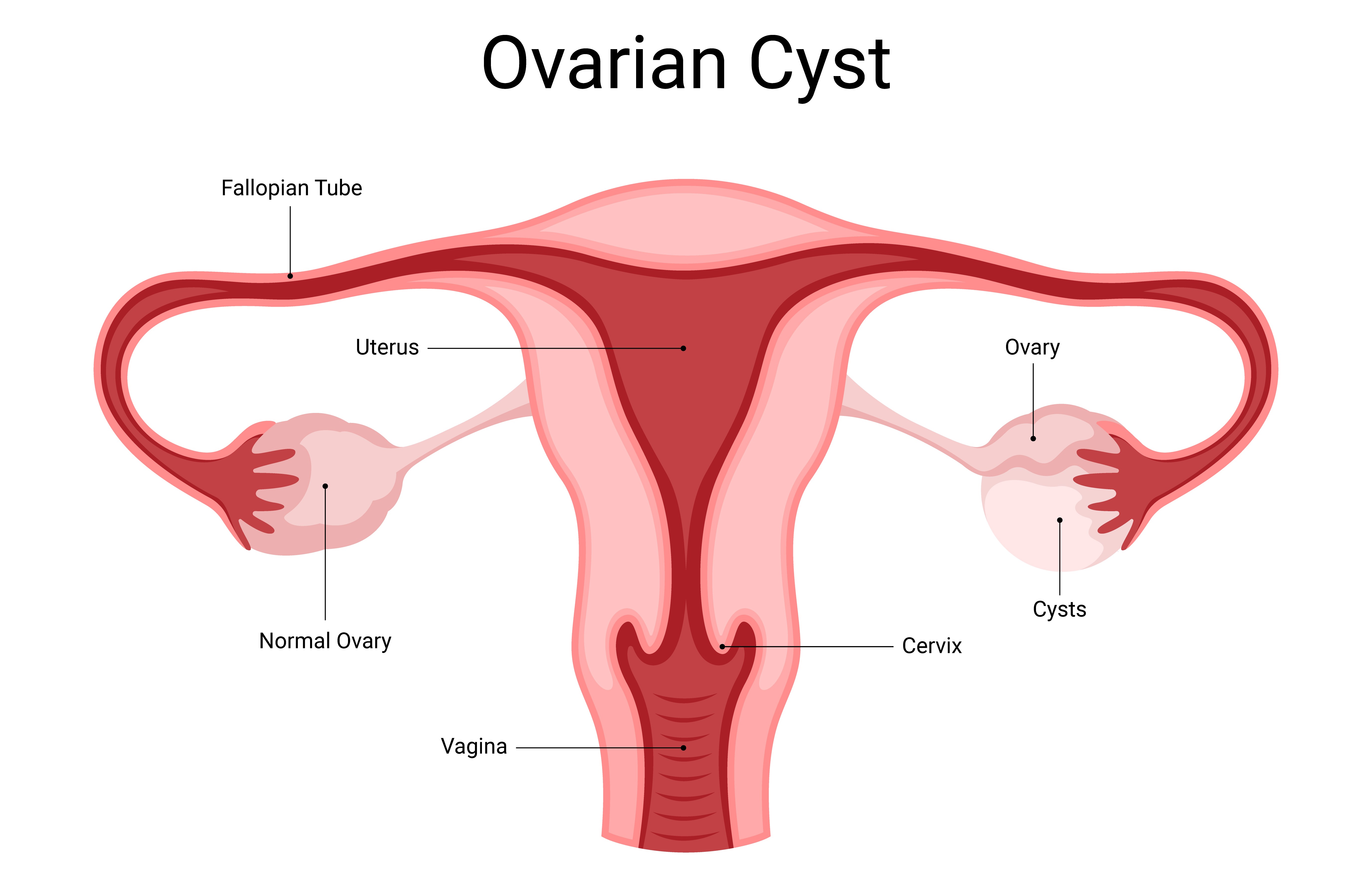 Ovarian Cyst Treatment in Chennai for Pain Reli... main image