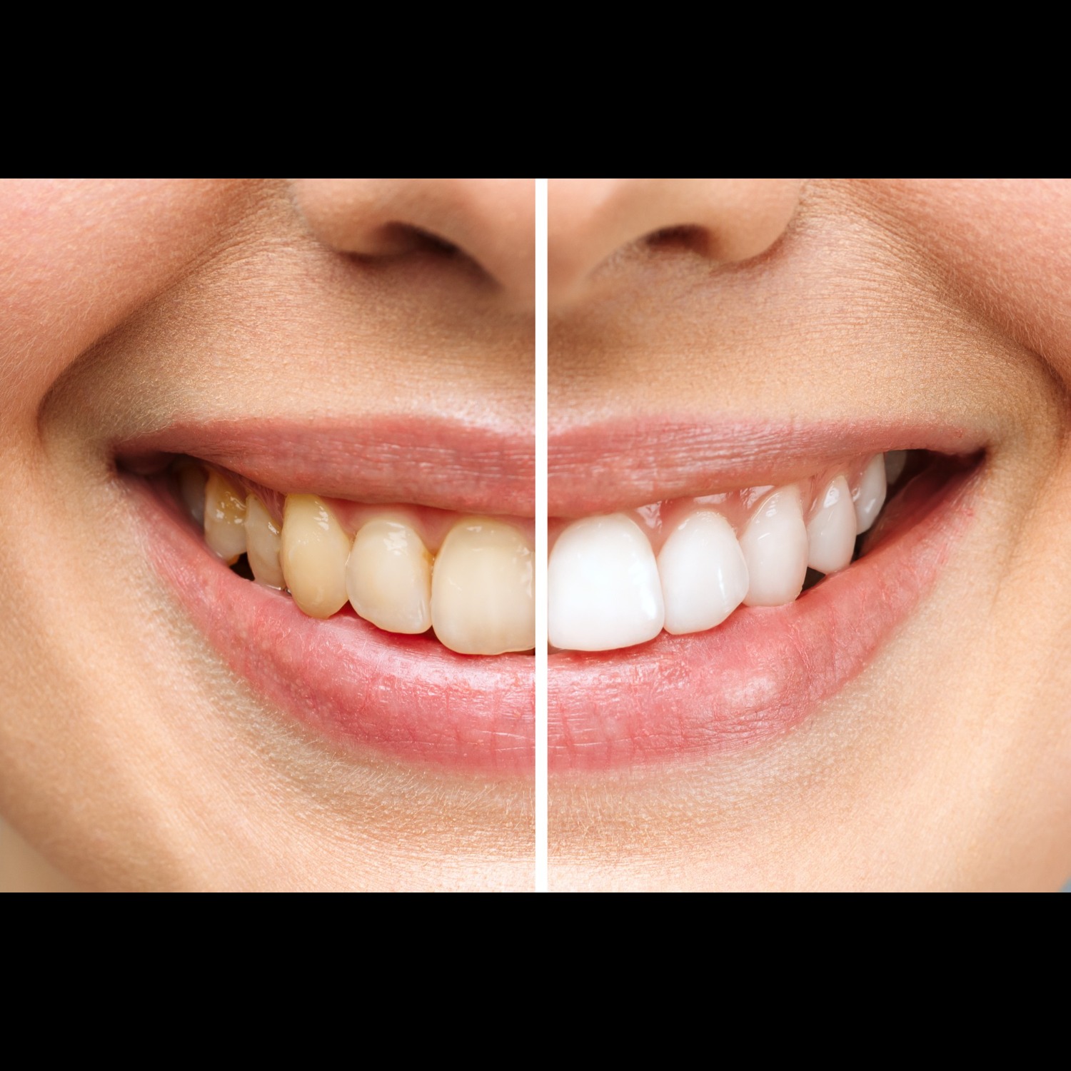 Teeth Whitening Dentist in Tagore Garden – Brig... main image