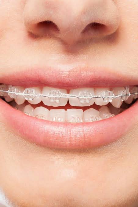 Orthodontics Bracket Treatment for Teens and Ad... main image