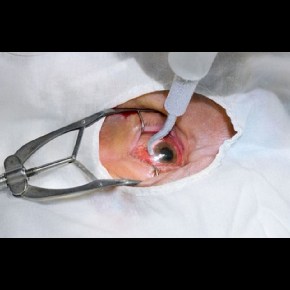Phacoemulsification Eye Surgery in Nagpur – Saf... main image