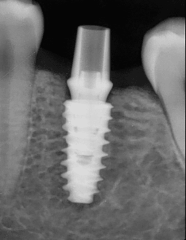 Osstem Implants in Delhi for Trusted Global Imp... main image