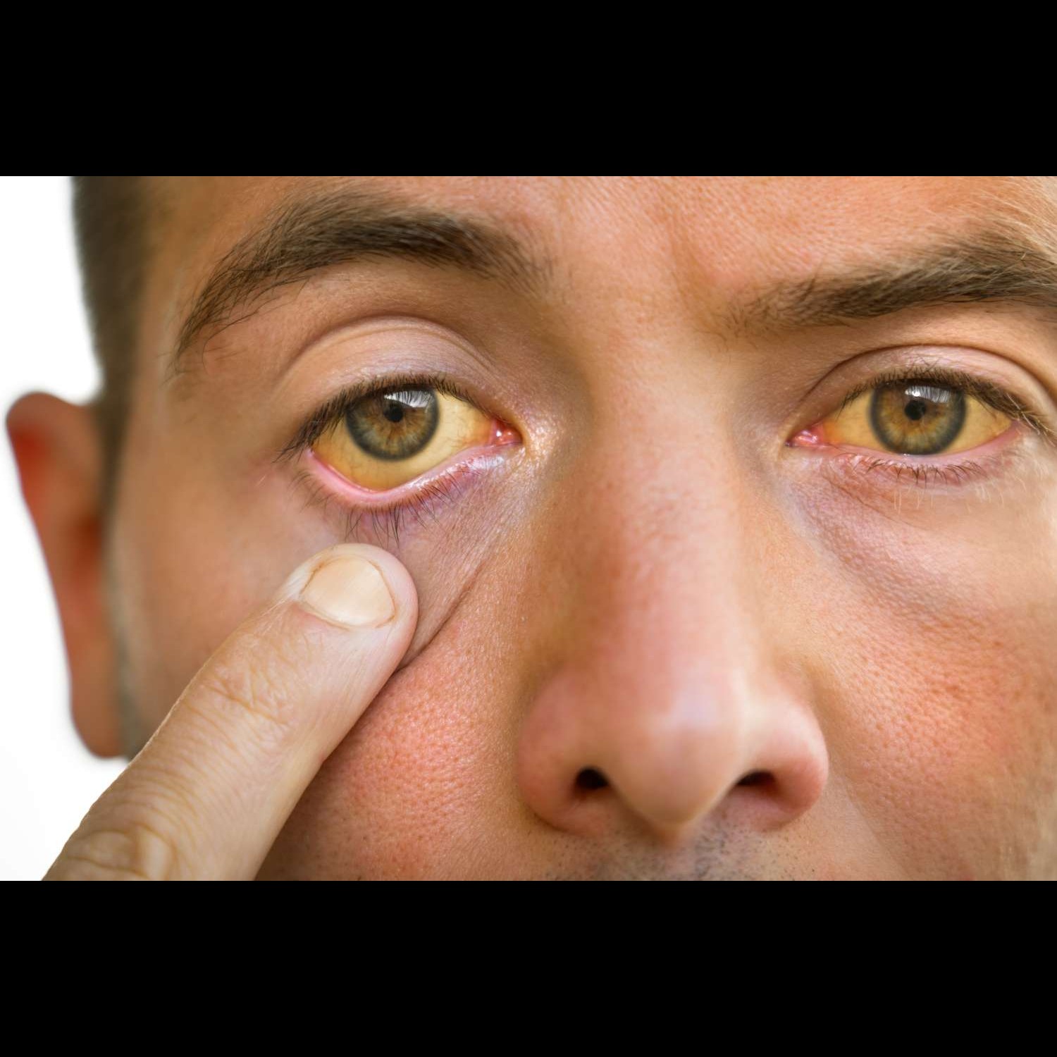 Best Jaundice Doctor in Jaipur Are you noticing... main image
