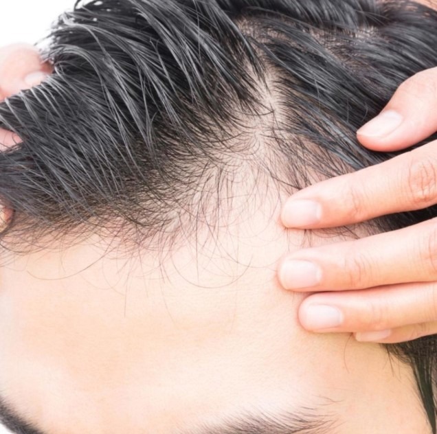 How can I make PRP treatment for hair loss more... main image