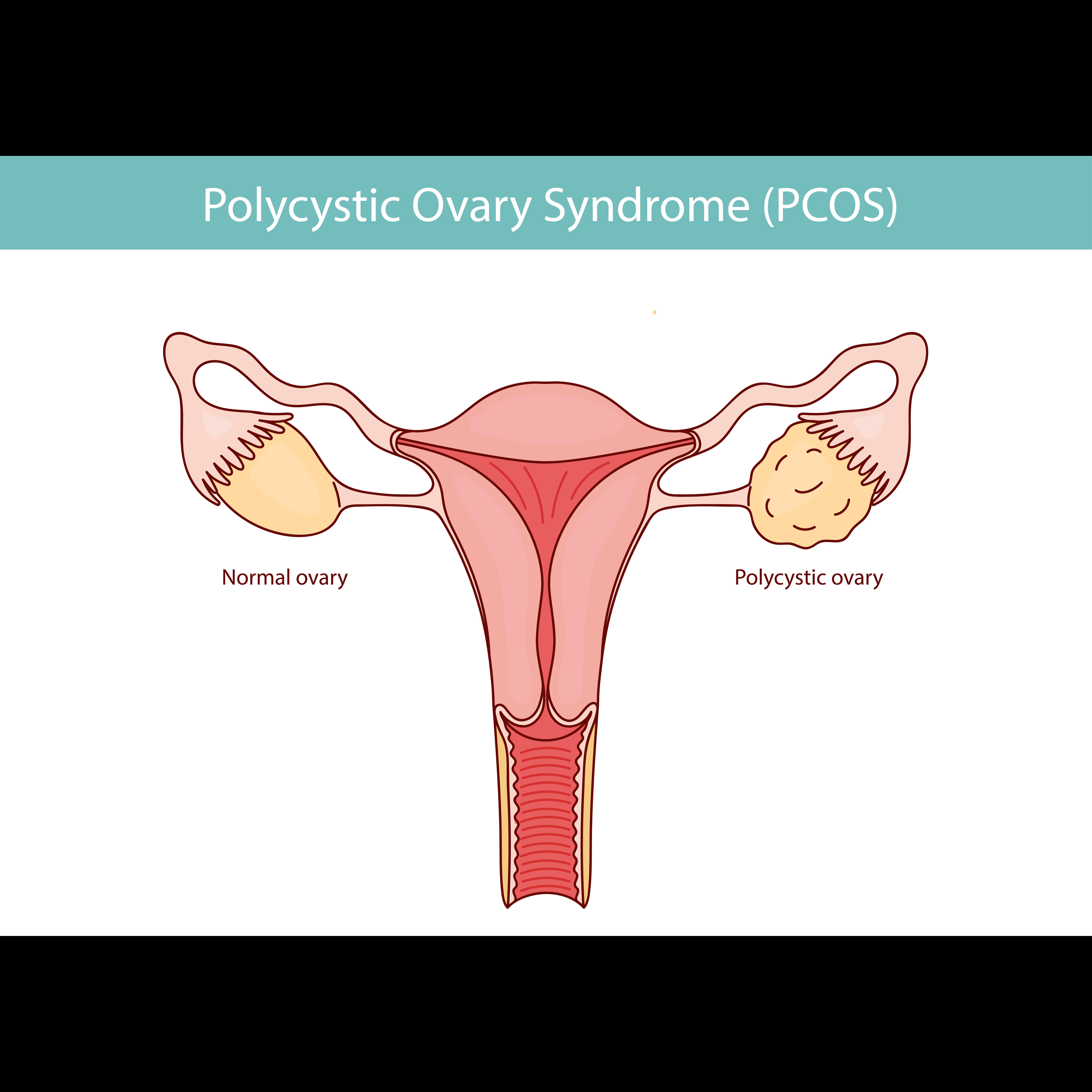 PCOS Treatment Support in Chennai – Manage Horm... main image
