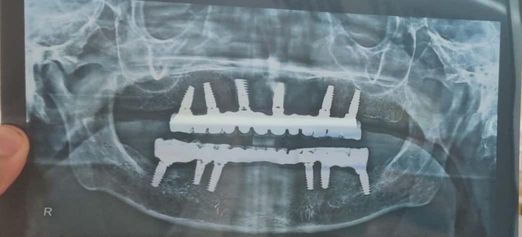 Implant doctors near me Dental implants in Mira... main image