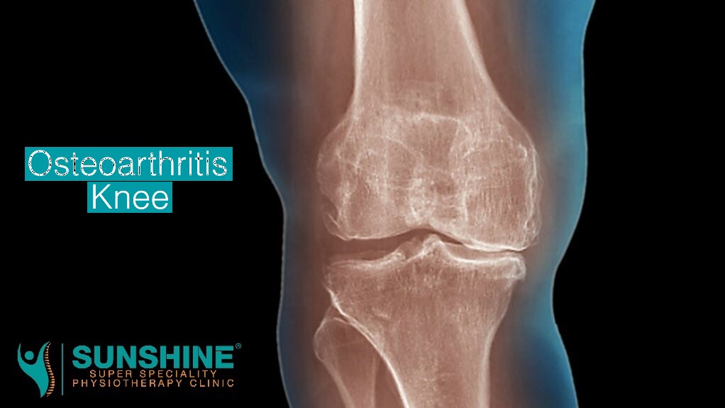 Struggling with knee pain from osteoarthritis? At ... main image