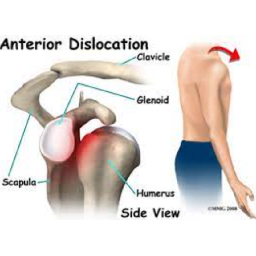 Advanced Solutions for Shoulder Dislocation and... main image