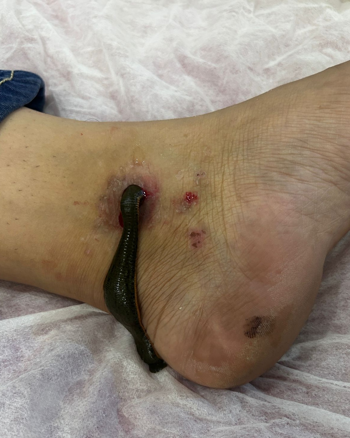 Leech Treatment In Uttam Nagar


Use of medical le... main image