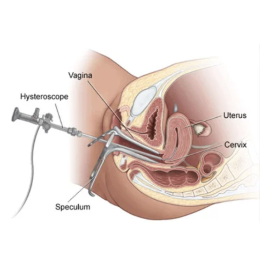 Hysteroscopic Polypectomy Surgery in Chennai – ... main image