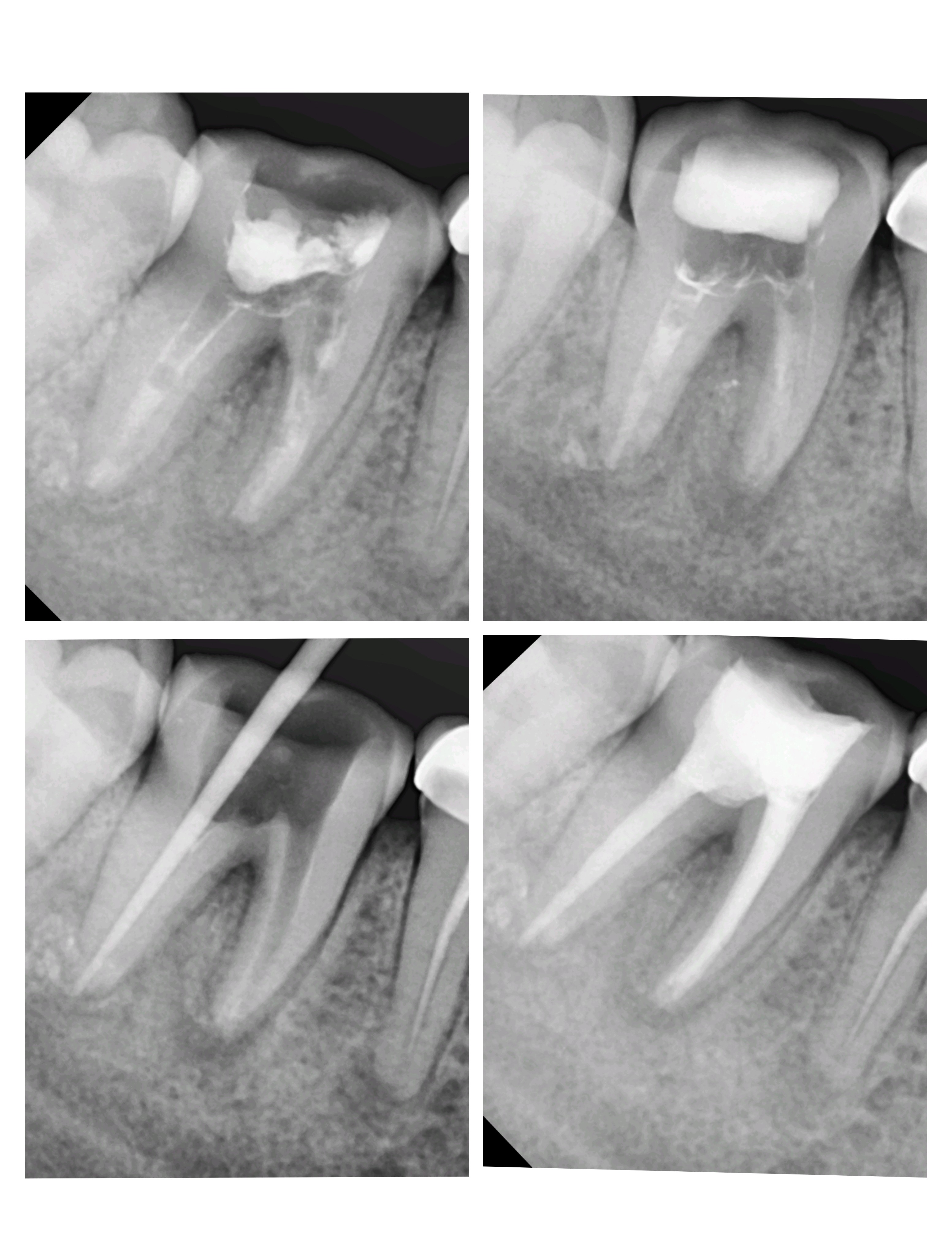 Re root canal treatment near me Failed root can... main image