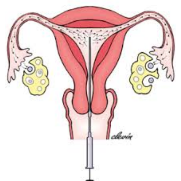 IUI Treatment in Chennai – A Simple & Effective St... main image