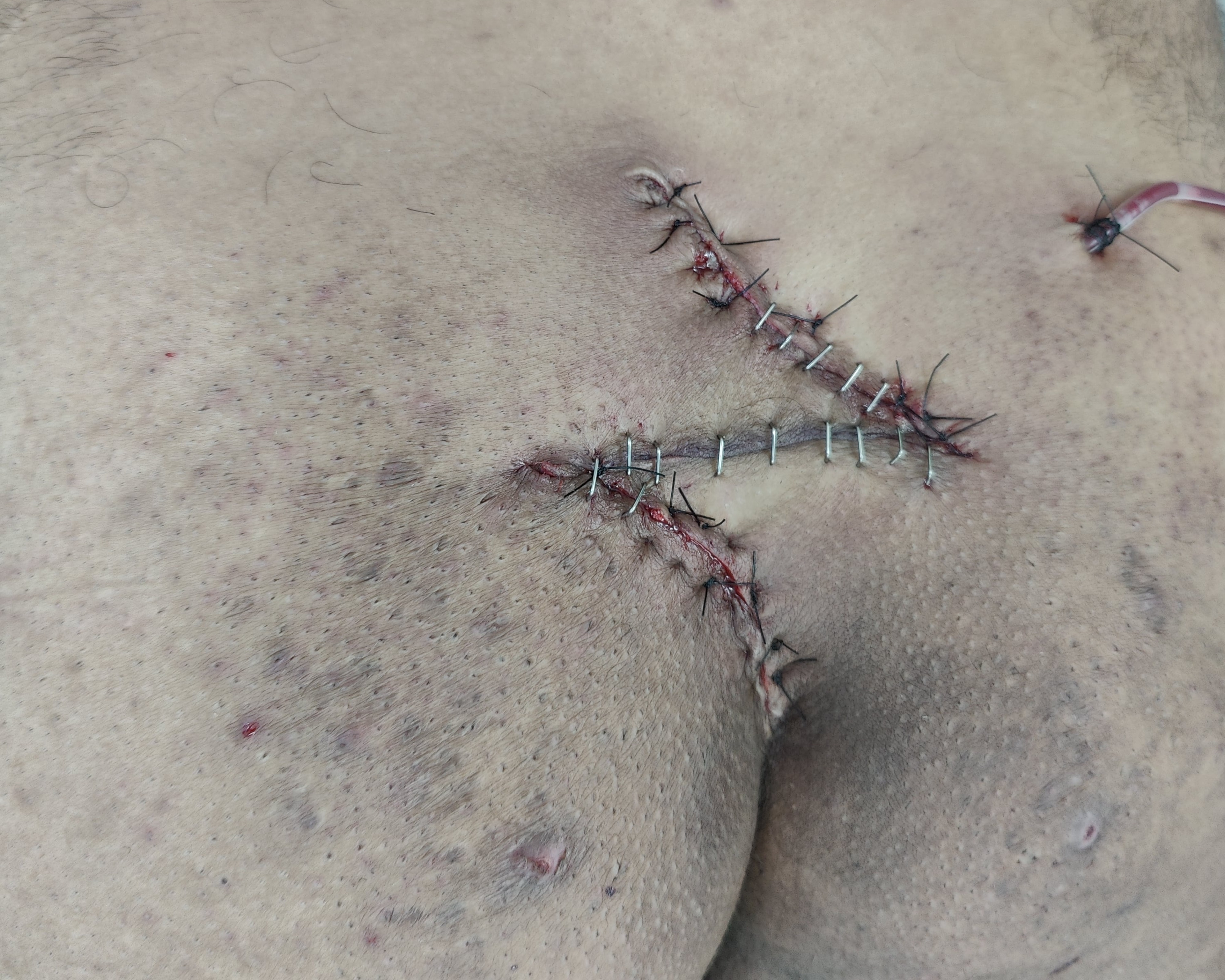 Pilonidal Sinus Surgery with Z-Plasty: Advanced... main image