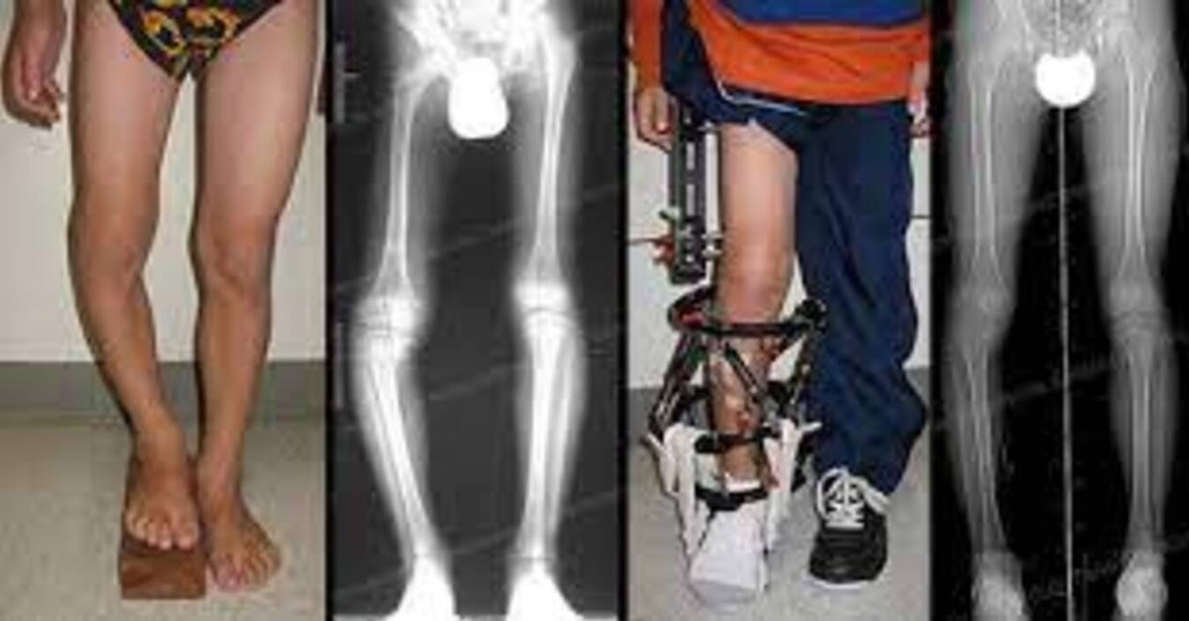 Limb Lengthening in Pune - Advanced Techniques ... main image