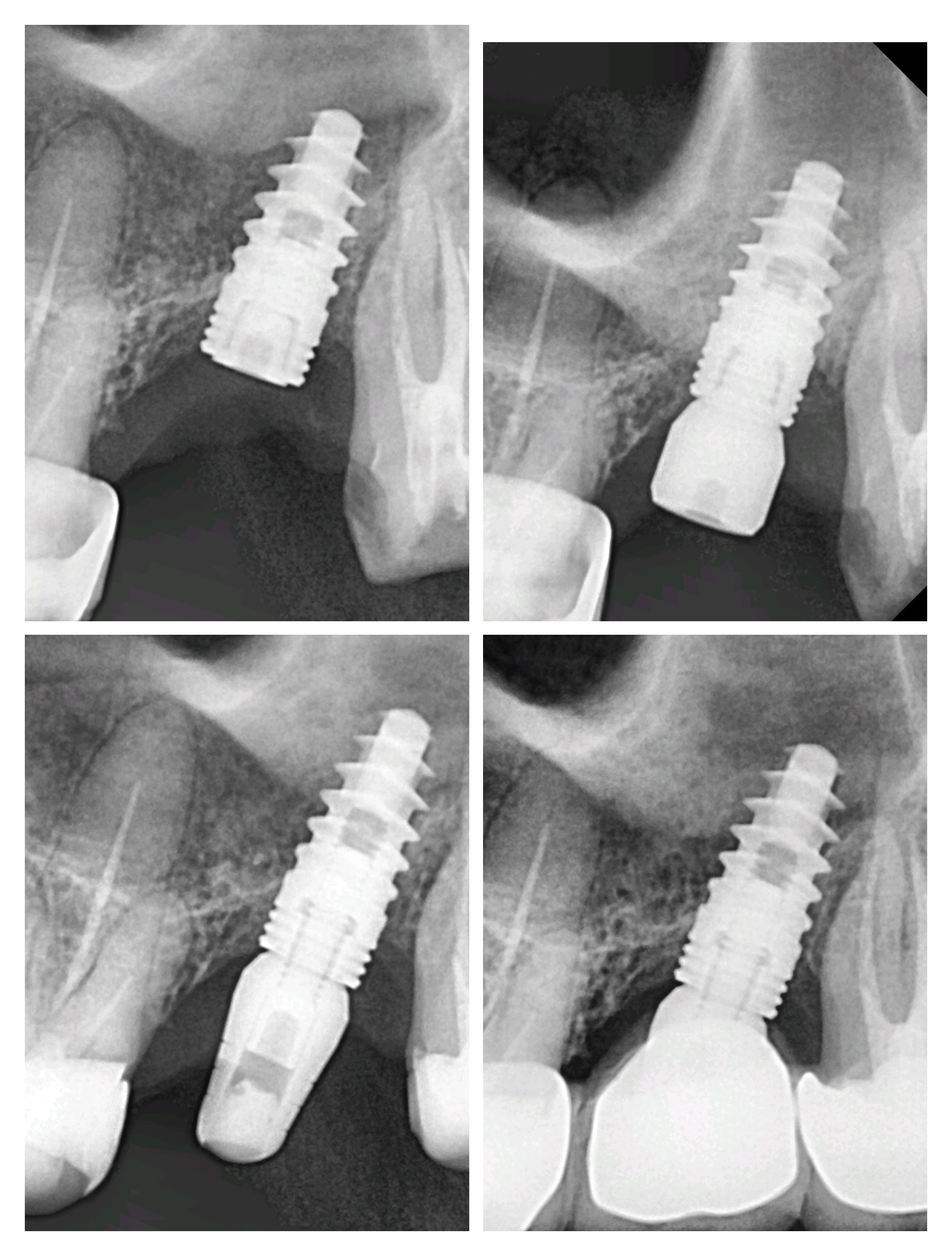 Permanent solution for missing teeth near me Si... main image